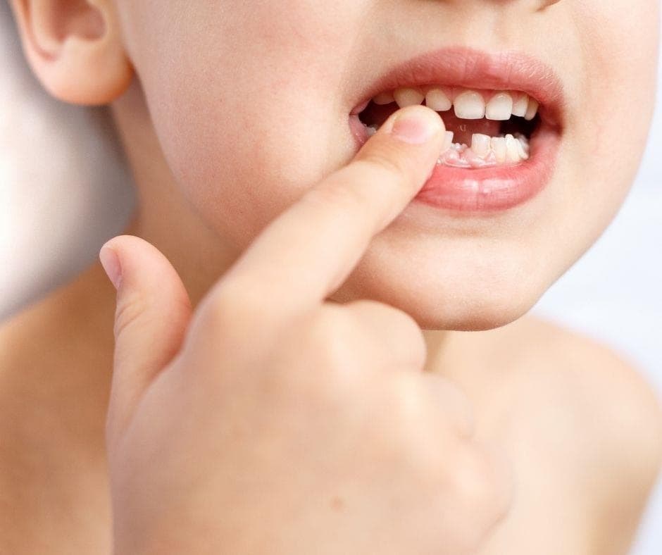 ¿Qué hacer cuando un diente de leche comienza a moverse?