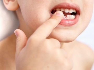 ¿Qué hacer cuando un diente de leche comienza a moverse?