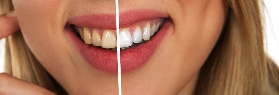 ¿Son recomendables los blanqueadores dentales que se comercializan?