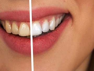 ¿Son recomendables los blanqueadores dentales que se comercializan?
