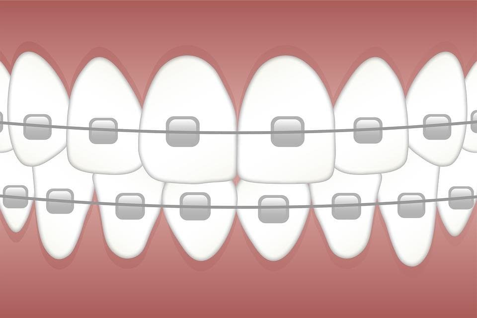 Tipos de ortodoncia: desde los brackets metálicos hasta la estética del Invisalign