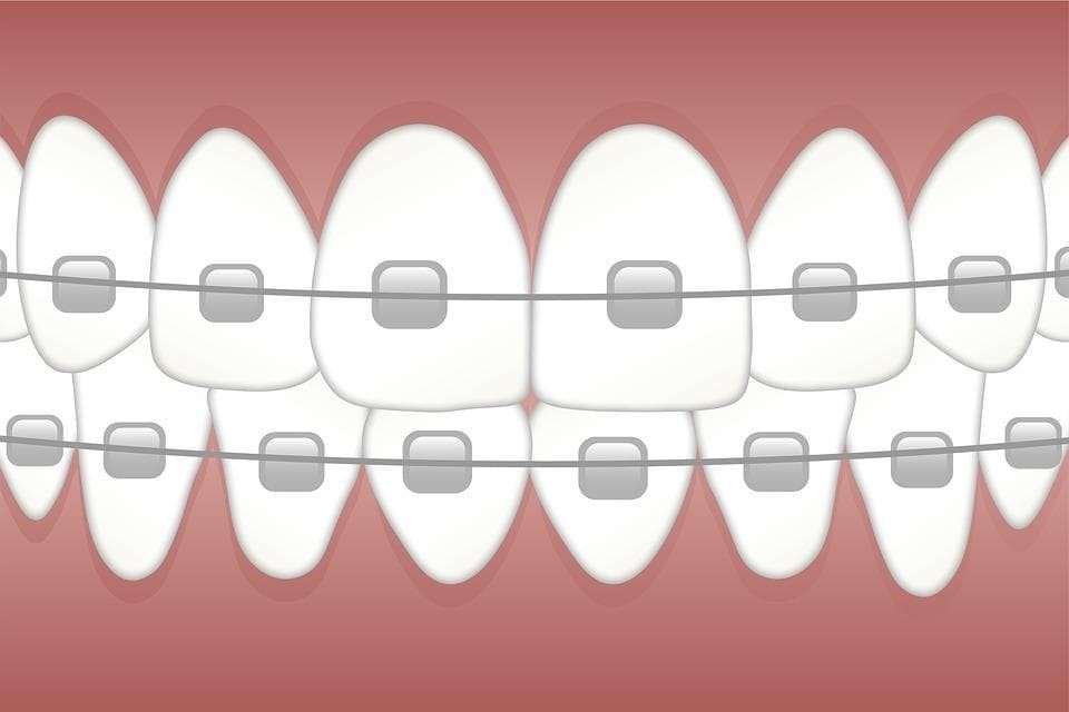 Tipos de ortodoncia: desde los brackets metálicos hasta la estética del Invisalign