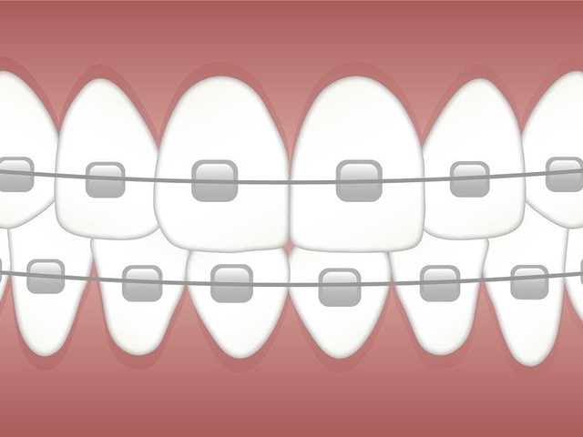 Tipos de ortodoncia: desde los brackets metálicos hasta la estética del Invisalign